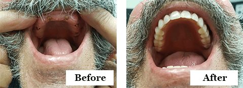 Before and After Dentures