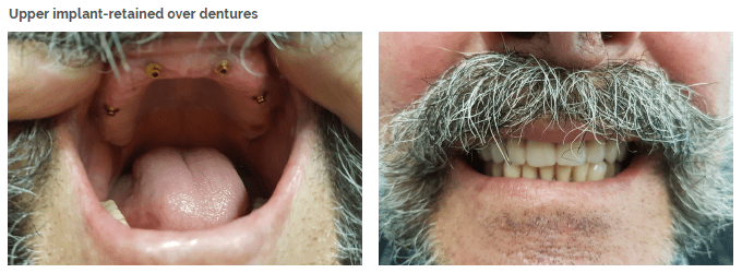 before and after dentures